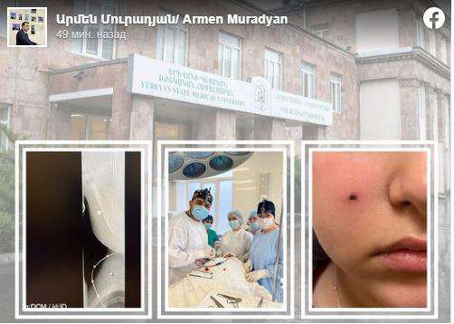 Врачи больницы Мурацан извлекли из щеки подростка металлический шарик