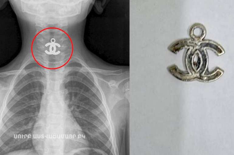 В Ереване врачи удалили металлический кулон из пищевода четырехлетнего ребенка