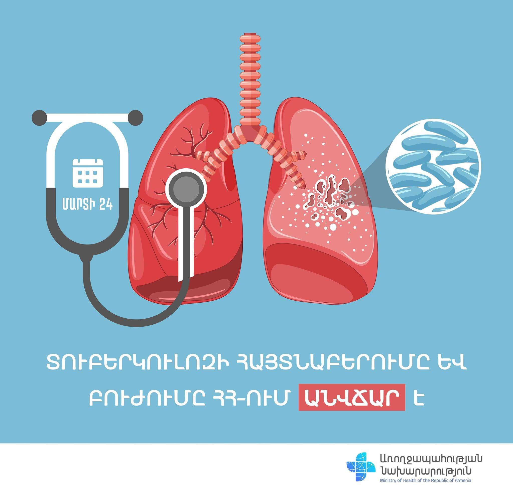 Այսօր Տուբերկուլոզի դեմ պայքարի համաշխարհային օրն է