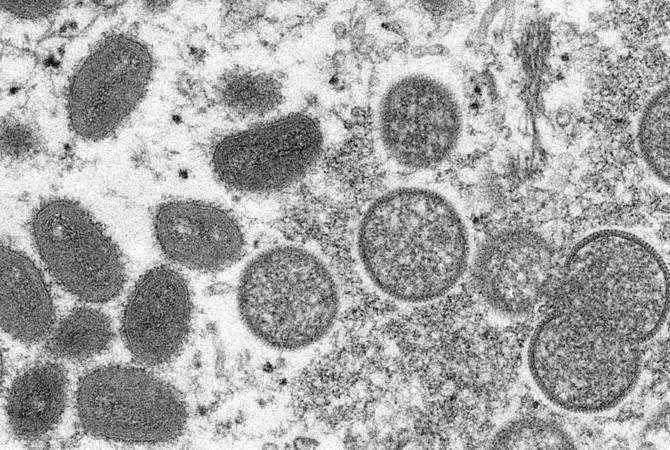 Ավստրիայում հոսպիտալացվել է կապկի ծաղկի կասկածանքով առաջին հիվանդը