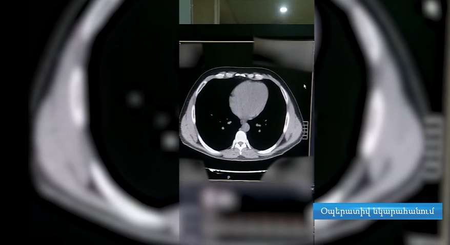 Հռոմից Երևան ժամանած քաղաքացու ստամոքսից ու հաստ աղիքից թմրանյութի պարկեր են հայտնաբերվել