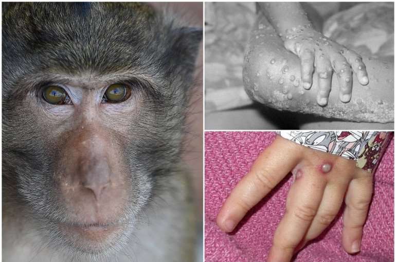 Ամբողջ աշխարհում կապիկի ծաղիկի հաստատված դեպքերի թիվը գերազանցում է 46.300-ը