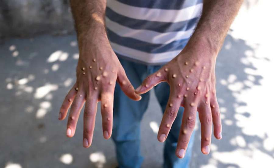 The first vaccination against monkeypox has begun in the Congo