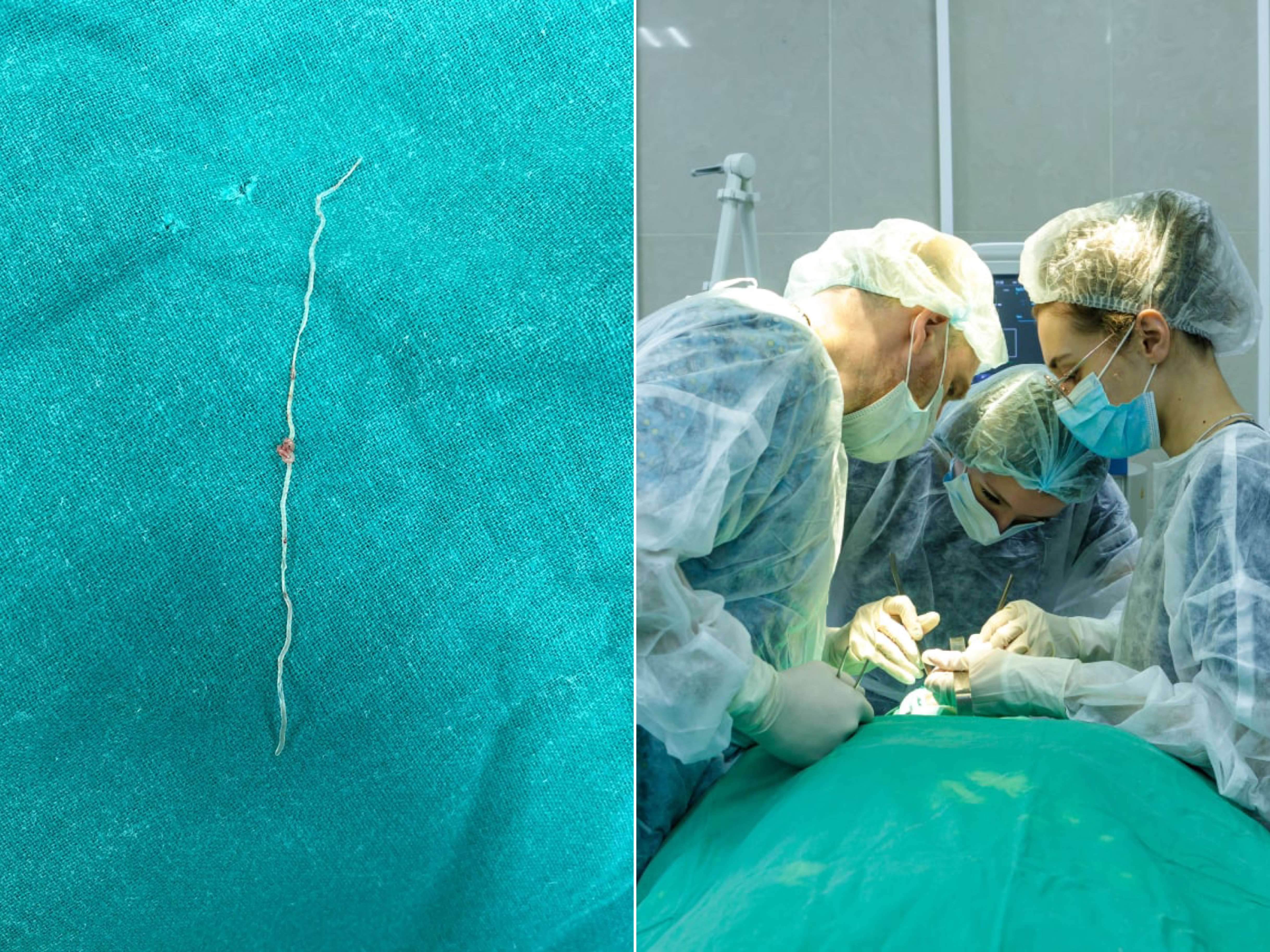 A 12 cm worm appeared in the cheek of a Muscovite after a mosquito bite (PHOTOS)